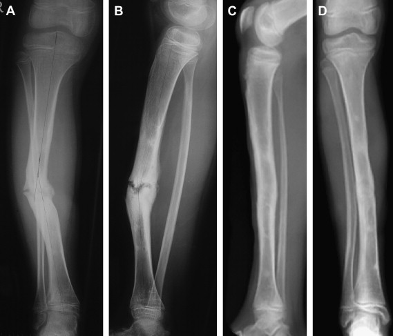 Non Union Fracture Treatment by Doctor Amith Shetty