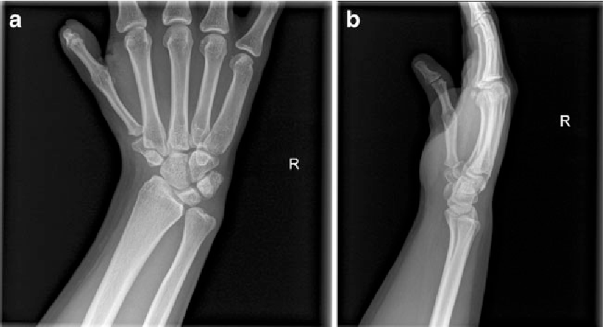 Malunion Fracture Treatment By The Dr. Amith Shetty