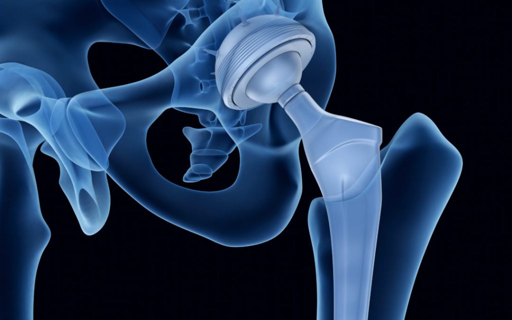 hip replacement surgery cost in bangalore
