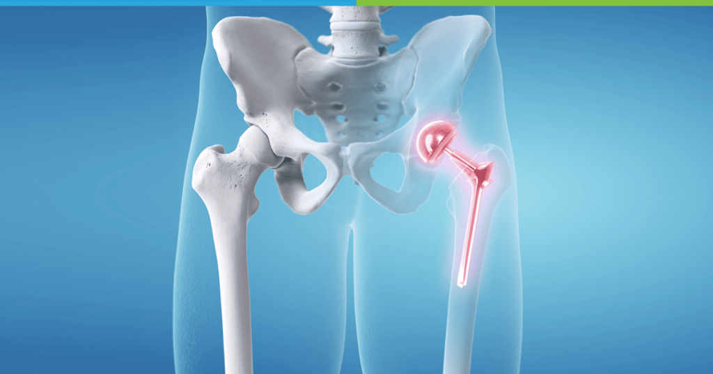 Primary & Revision Hip Replacement - Dr Santosh Shetty