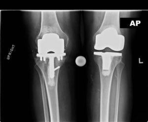 knee replacement surgery in bangalore