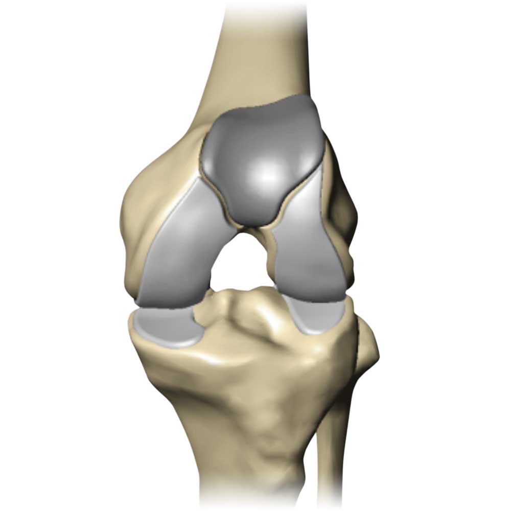 best knee replacement surgery doctors in bangalore