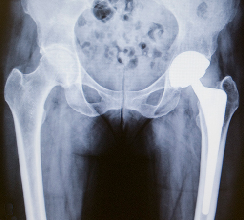 hip replacement surgery in bangalore